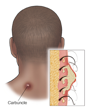 Back view of man's head and neck with carbuncle on neck. Inset shows cross section of carbuncle.