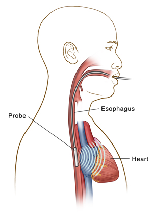 Side view of male head and chest showing probe in esophagus for transesophageal echo.