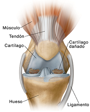 Vista frontal de una rodilla con osteoartritis.