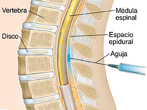 Corte transversal de la parte inferior de una columna con una aguja introducida justo fuera del saco alrededor de la médula espinal.