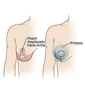 Dos imágenes de un pecho femenino que ilustran el brazo y la mama derechos. La primera figura muestra las incisiones y el tejido extirpado para la mastopexia; la segunda figura muestra el implante mamario colocado.