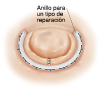 Vista superior de válvula del corazón reparada con un anillo en forma de C cosido alrededor de la válvula.