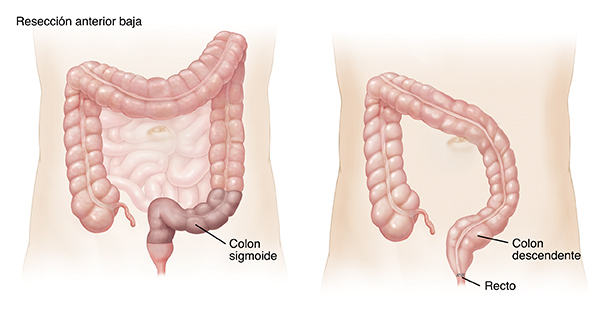 Contorno de un abdomen de adulto donde se observa el intestino grueso y el intestino delgado. Área sombreada en el colon sigmoide y recto que indica una resección anterior baja. Contorno de un abdomen de adulto donde se observa el colon descendente unido al recto, luego de una resección anterior baja.