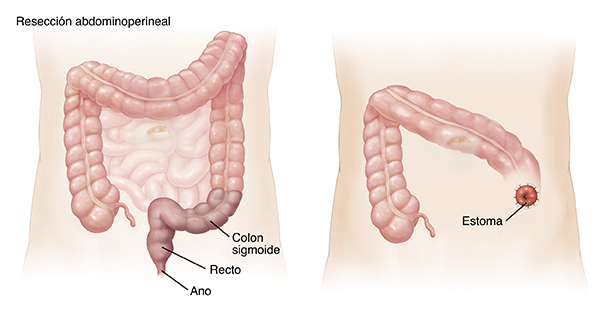 Contorno de un abdomen de adulto donde se observa el intestino grueso y el intestino delgado. Área sombreada en el colon sigmoide, recto y ano que indica una resección abdominoperineal. Contorno de un abdomen donde se observa un estoma luego de una hemicolectomía izquierda.