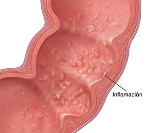 Corte transversal del colon donde puede verse colitis ulcerosa.