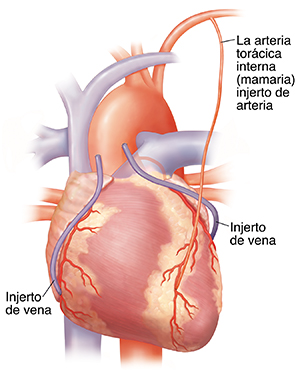 Vista frontal del corazón que muestra tres injertos de derivación en las arterias coronarias.