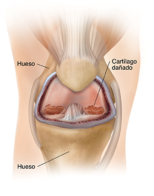 Vista frontal de una articulación de rodilla con artritis. de rodilla con inflamación y artritis.