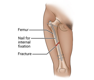 Front view of thigh showing fracture in femur with internal fixation (flexible nails).