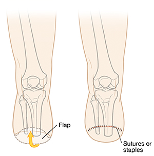 Front view of leg showing two steps in amputation of leg below the knee with skin flap brought around from the back and sutured to the front.